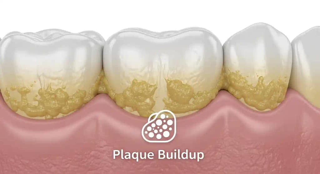 Dental infographic showing common causes of gum recession such as smoking, plaque, and hard brushing