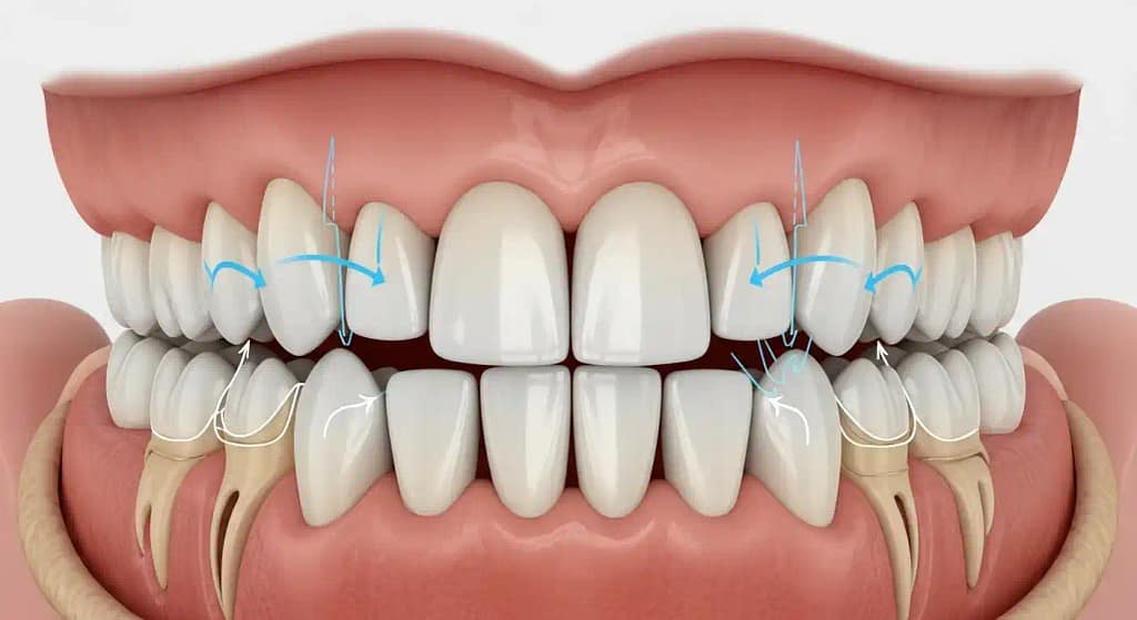 3D illustration showing how tongue position affects teeth alignment.