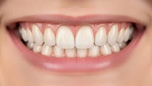 ceramic teeth cap on front teeth with natural smile